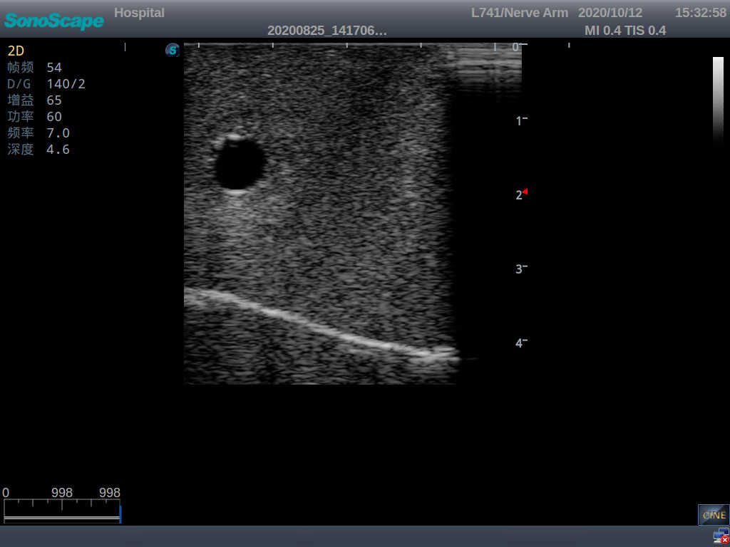 Central Venous Catheterization Ultrasound Training Model